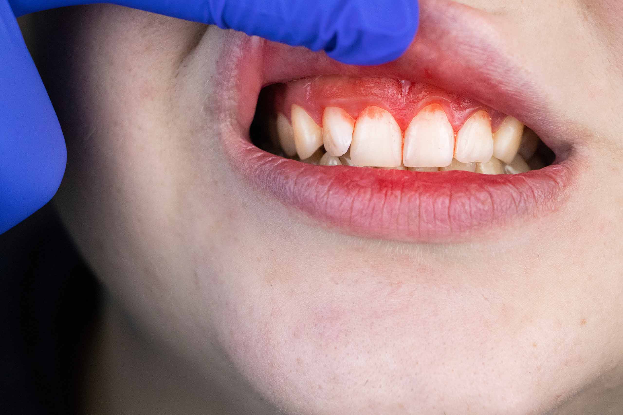 Gum Treatment